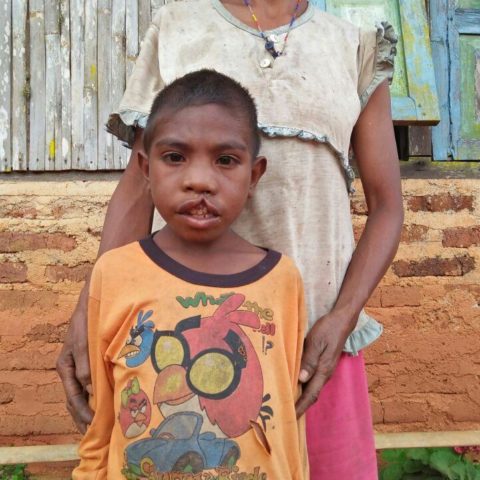 little boy cleft lip stichting kolewa foundation indonesia rote island mom